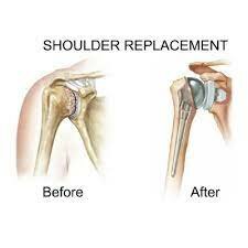 Shoulder Replacement - Dr. Amit Agarwal