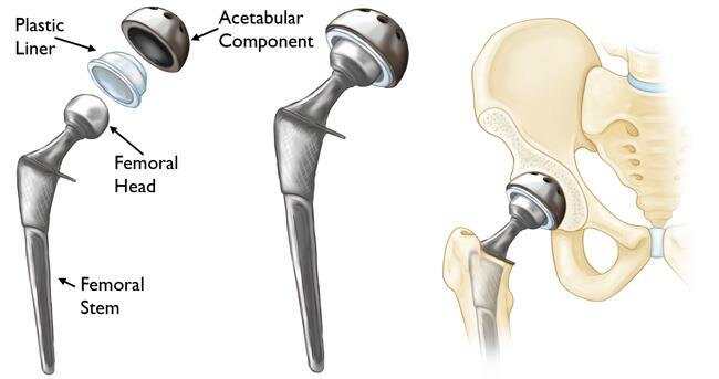 Total Hip Replacement - Dr. Amit Agarwal