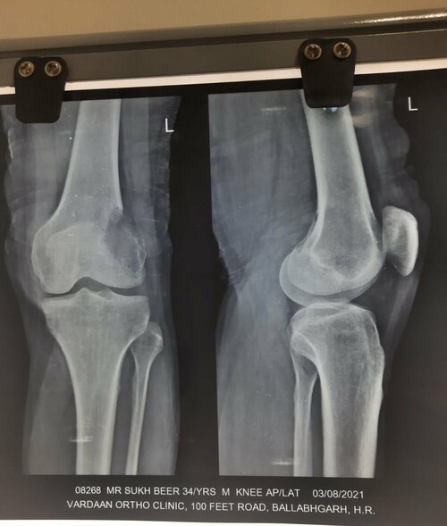 Giant cell Tumor of distal femur condyle case | Dr. Amit Agarwal|Dr Amit K Agarwal|Jasola Vihar,New Delhi