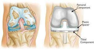 Total Knee Replacement - Dr. Amit Agarwal