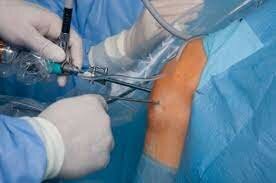 Thumbnail of topic : Arthroscopic Surgery - Dr. Amit Agarwal
